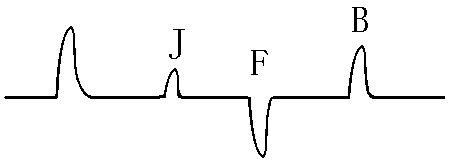 中間有接頭的電纜脈沖反射波形 中間有接頭的電纜脈沖反射波形
