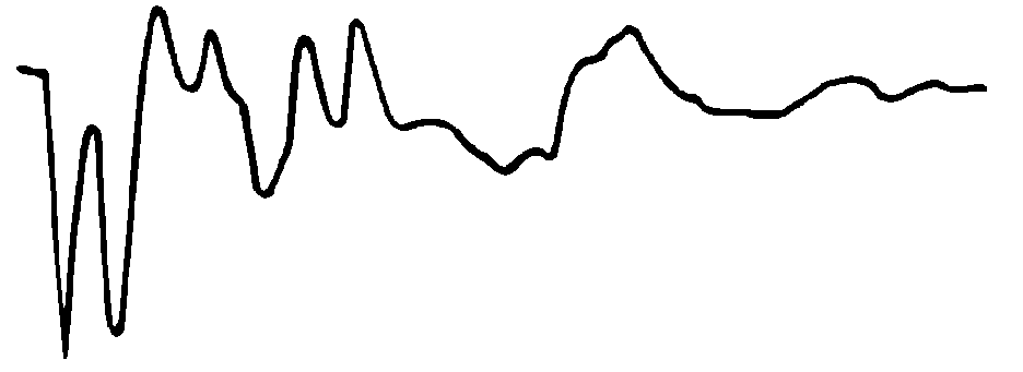 無遠(yuǎn)端短路環(huán)波形 無遠(yuǎn)端短路環(huán)波形